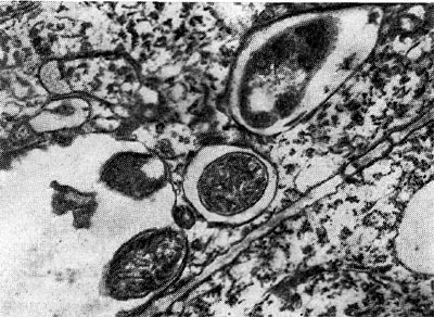 –ис. 157. ¬ыход клубеньковых бактерий в ткань корн¤ из везикулоподобных образований инфекционных нитей (по √удчильду и Ѕергерсену).